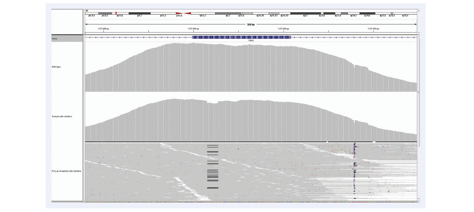 <b>Figure 11:</b> Superior uniformity of coverage allows reliable detection of indels even as big as 1/3 of a read length. Shown here 52bp deletion in exactly the same region as illustrated in Figure 10, exon 9 of the <i>CALR</i> gene. 23% deletion (c.1092_1143del_52bp). Mean target coverage >1000, 24 samples per MiSeq lane, using the SureSeq Myeloid panel.